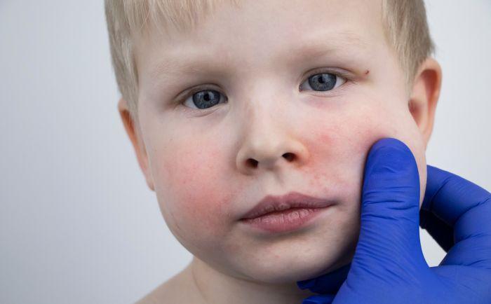 manchas blancas en la cara niños prevenir