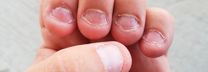 Onicofagia qué es y cómo vencer el mal hábito de morderse las uñas