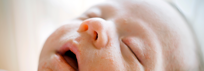 Granitos del recién nacido: el acné neonatal