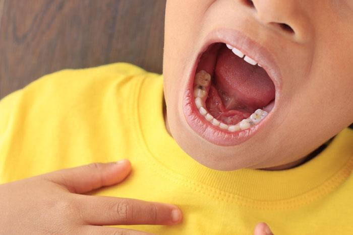 Niño con la boca abierta mostrando sus caries