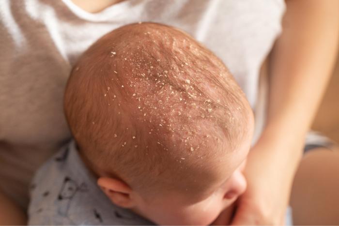 Bebé con costra láctea o dermatitis seborreica