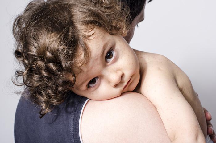 Madre sosteniendo a su hijo enfermo de roseola