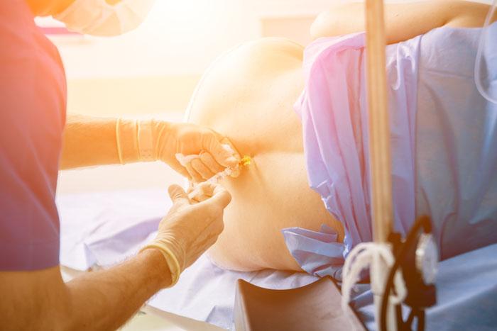Anestesia aplicando una epidural a una mujer de parto