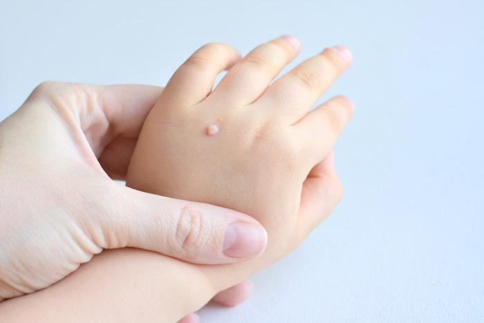 Adulto sosteniendo la mano de un niño con verrugas en la mano