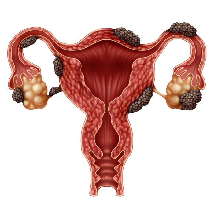 endometriosis embarazo natural