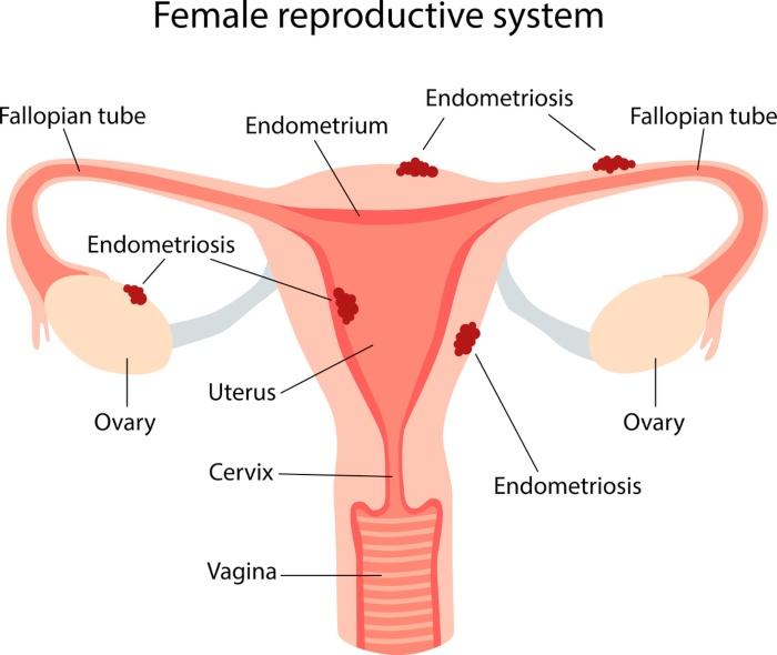endometriosis embarazo natural aparto reproductor