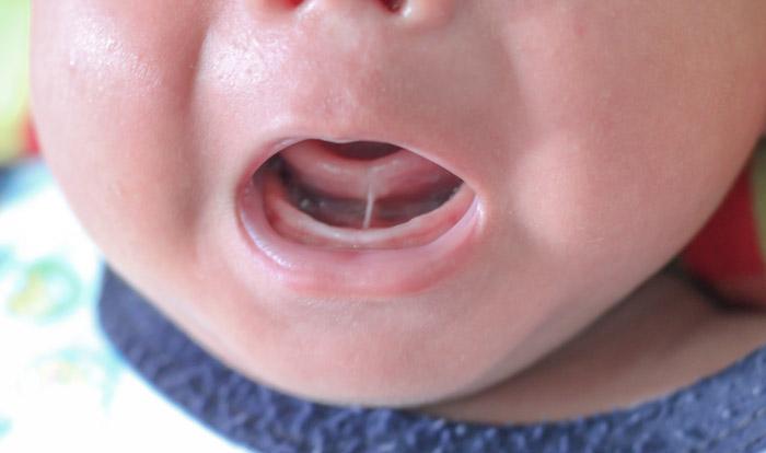 Boca de recién nacido en la que se ve un frenillo corto