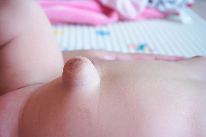 Imagen de la hernia umbilical de un bebé