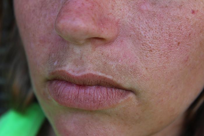 Parte de un rostro de una mujer con melasma en el labio superior