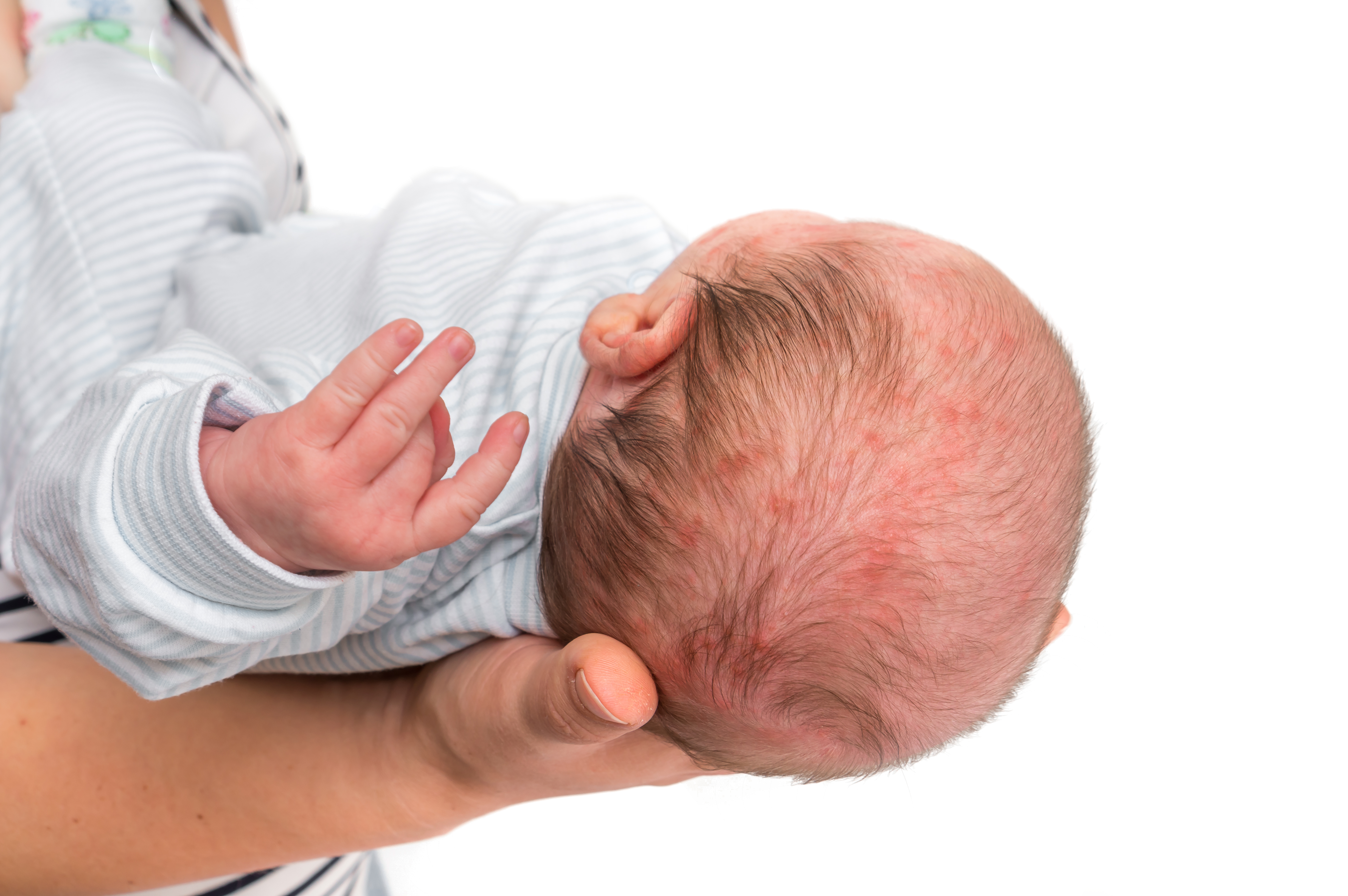 Cabeza de recién nacido con acné neonatal