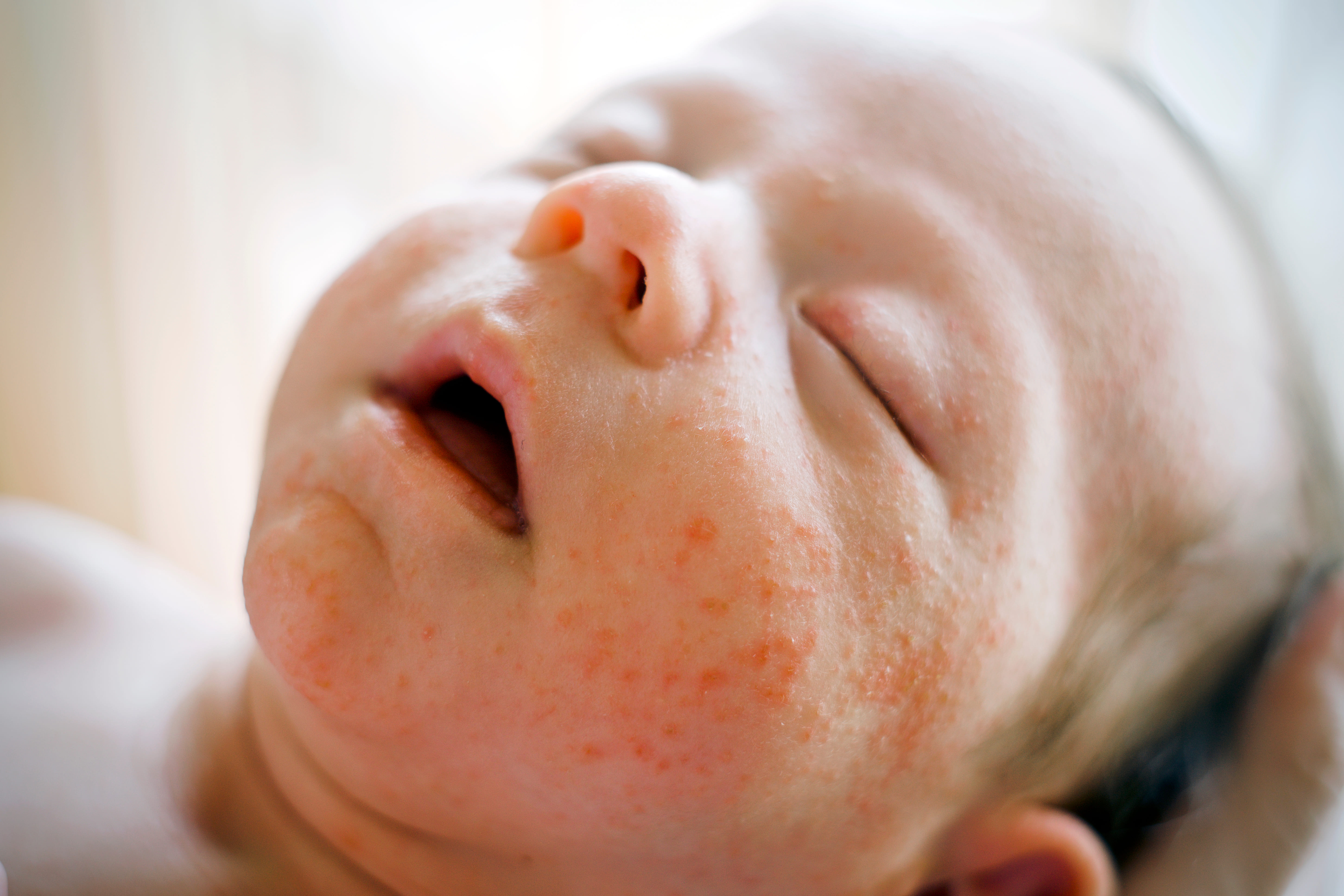 Recién nacido dormido con acné neonatal 