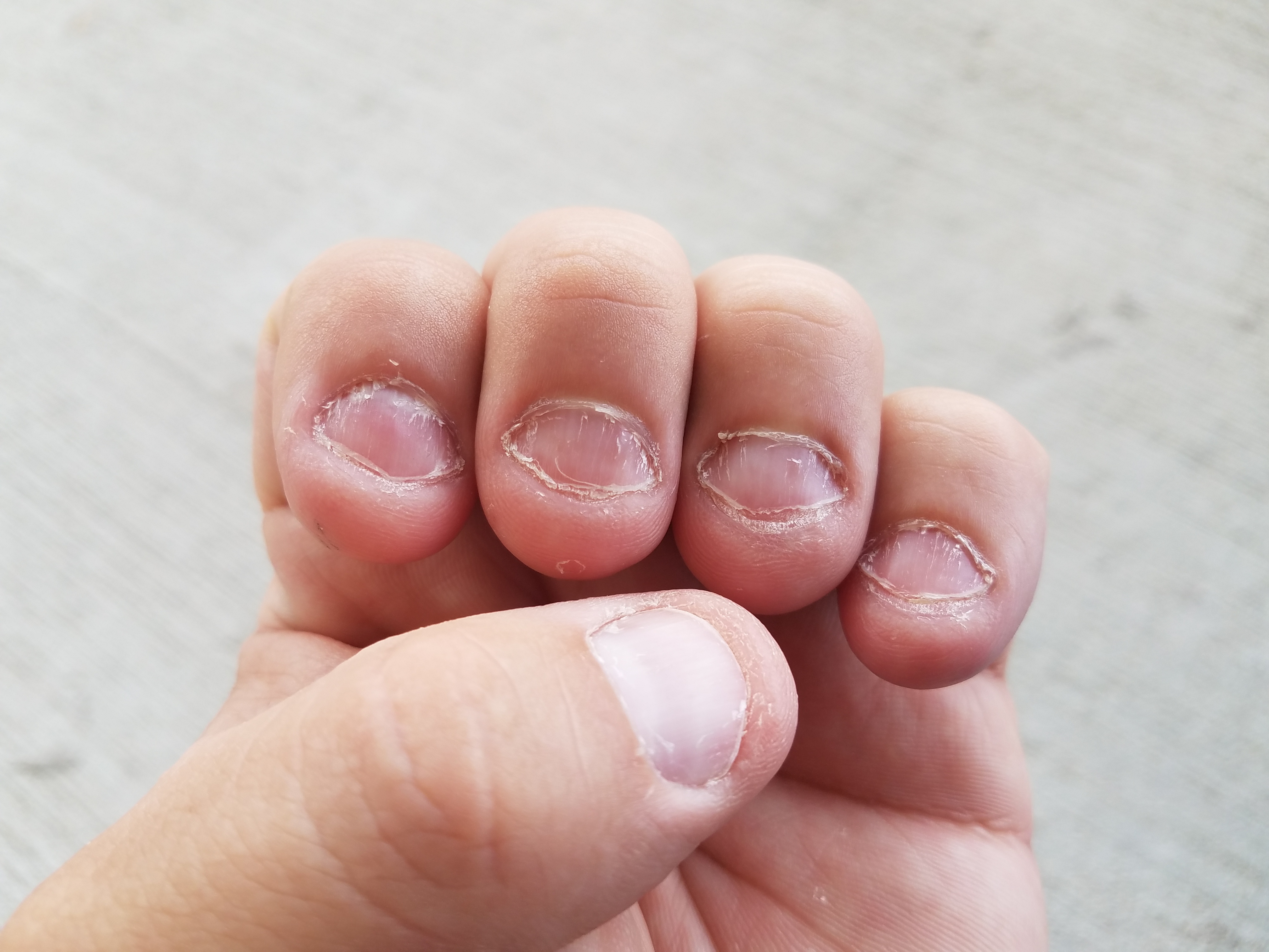 Dejar De Morderse Las Uñas En 33 Dias