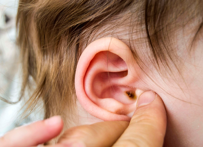 Primer plano del oído de un bebé con supuración por otitis media aguda 