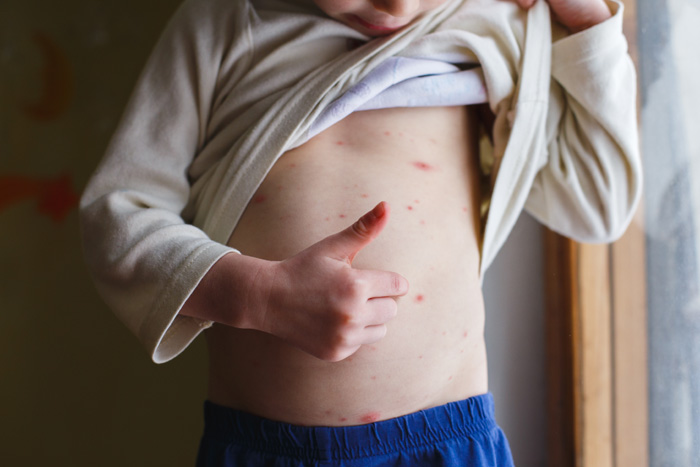 Niño levantándose la camiseta y rascándose la piel con varicela