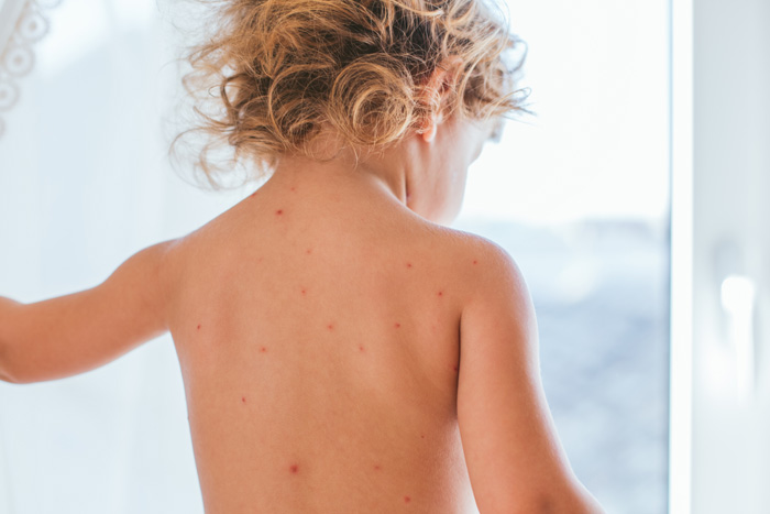 Niño con la espalda llena de granos de varicela